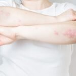 New Report Reveals Widespread Stigma of Psoriasis May Be Contributing to Dangerous Delays in Care