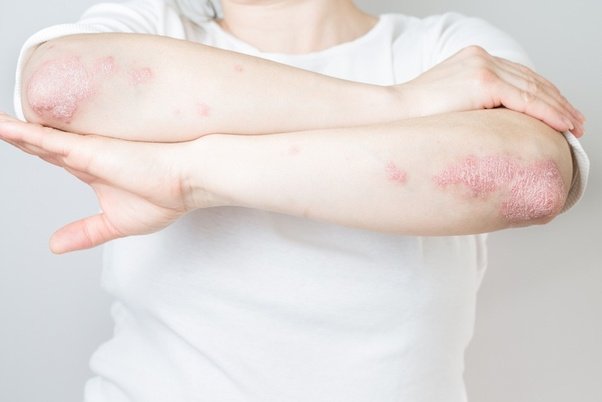 New Report Reveals Widespread Stigma of Psoriasis May Be Contributing to Dangerous Delays in Care