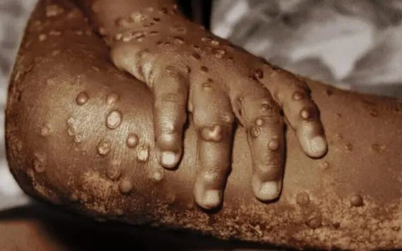 mpox cases